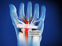 Carpal Tunnel