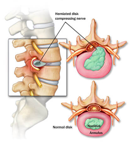 Top Herniated Disc Doctors in NJ & NYC