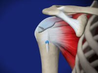 Rotator Cuff Injury