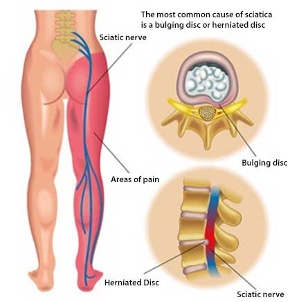 Sciatica Pain: Immediate Relief, Cure Sciatica Permanently - NJ's