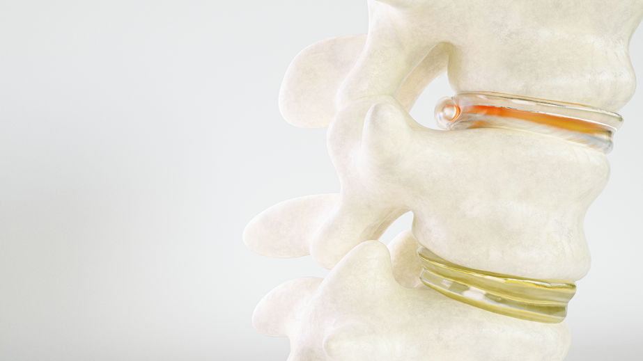 Spinal disc herniation as close-up detailed 3D Rendering