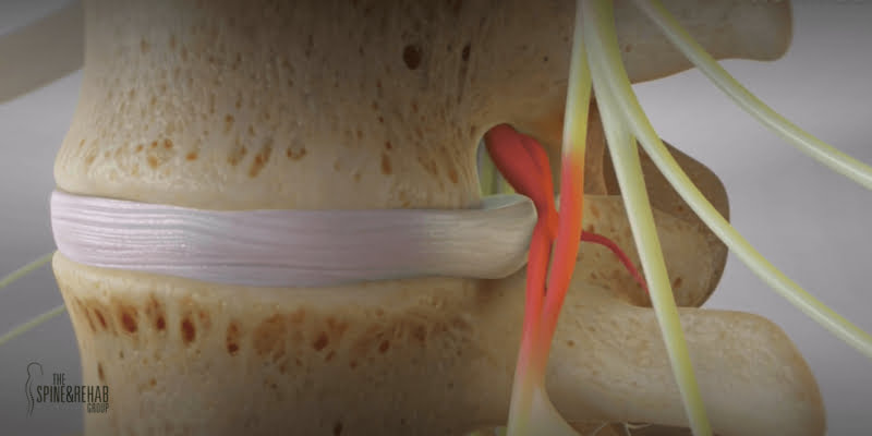 Herniated Disc