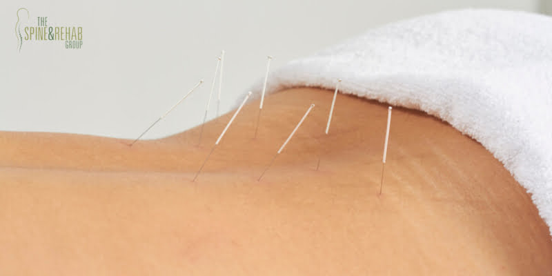 acupuncture needles in lower back