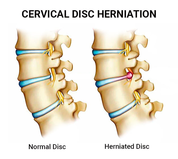 Cervical Disc Herniation Doctors NJ & NYC