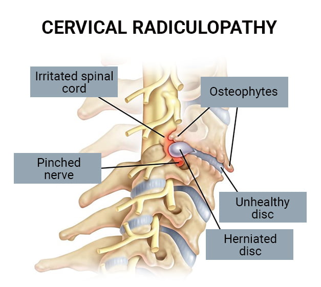 Pinched Nerve (Cervical Radiculopathy)