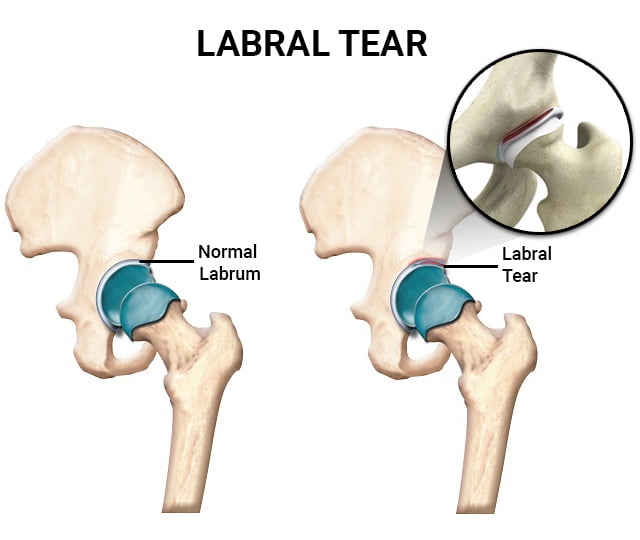 Hip Labral Tear Recovery Without Surgery