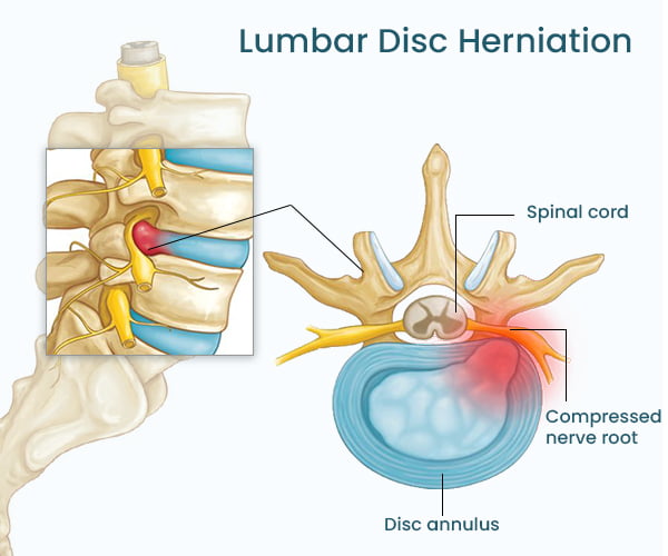 What is Lumbar Disc Herniation/Sciatica & How to Manage It? - Upswing Health