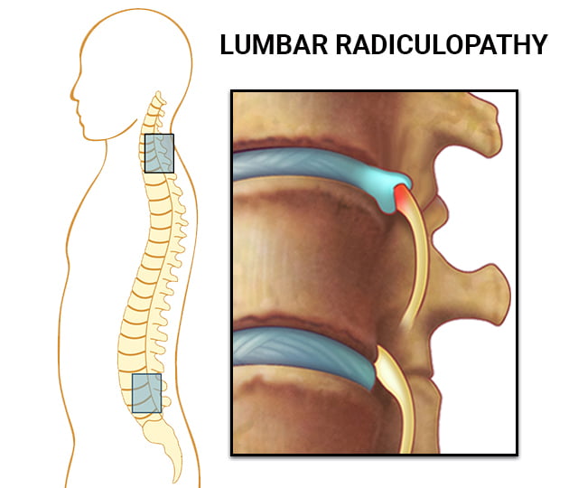 Anatomy of Lumbar Radiculopathy