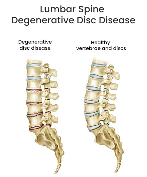 Anatomy of Lumbar Spine Degenerative Disc Disease