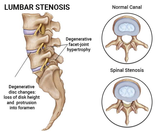 Anatomy of Lumbar Stenosis