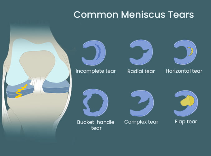 medial meniscus tear