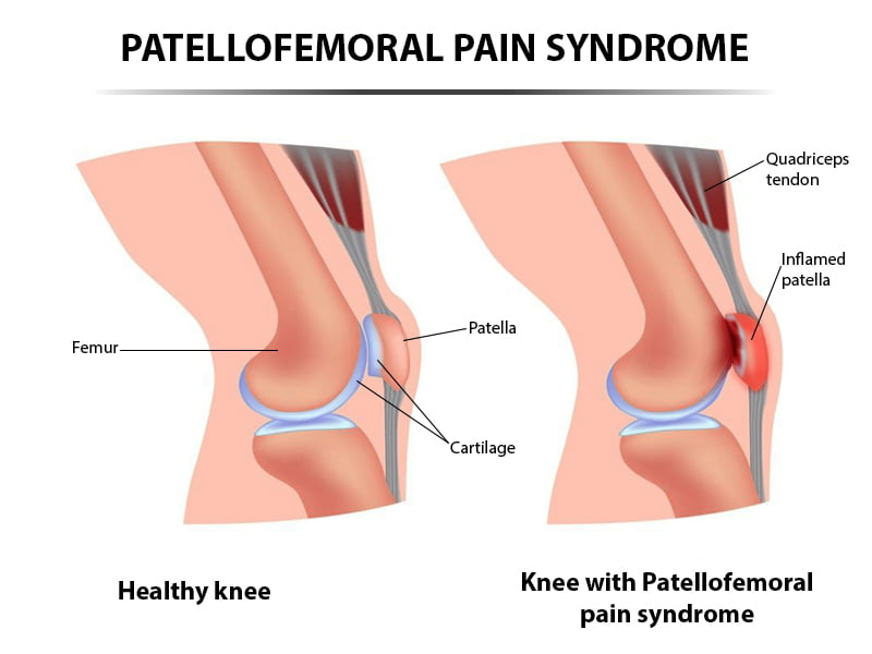 Iliotibial Band Syndrome Treatment in NYC