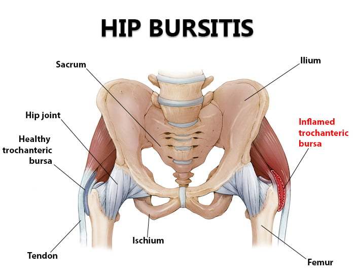 Hip Bursitis Overview: Symptoms Causes & Diagnosis