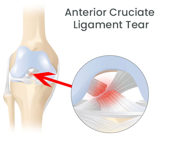 Anterior Cruciate Ligament Tear (ACL Tear) in NJ & NYC