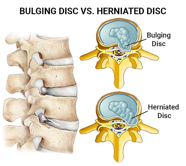 The Best Sleeping Position For Herniated Disc & Bulging Discs 