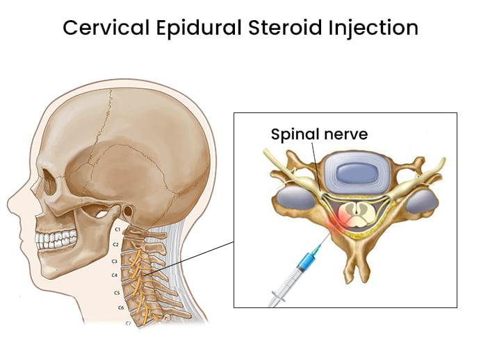 Cervical Epidural Steroid Injection