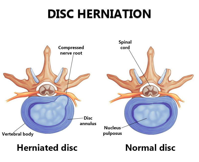 Herniated Disc in Davenport, IA