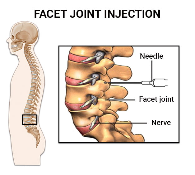 Facet Joint Injections