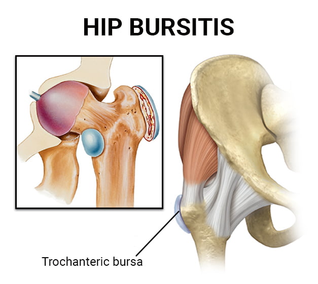 Hip pain: What causes it? What can you do about it?