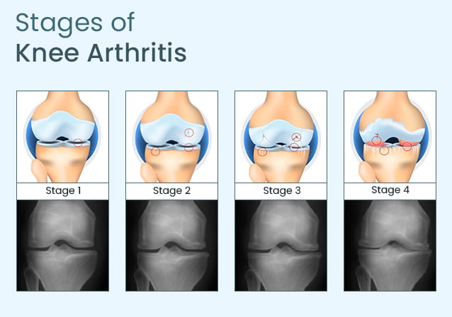 Anatomy of Knee Arthritis