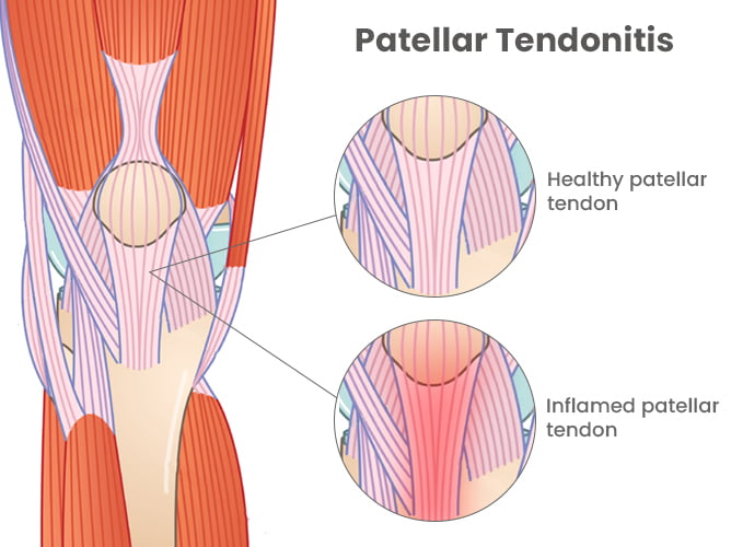 Patellar Tendonitis