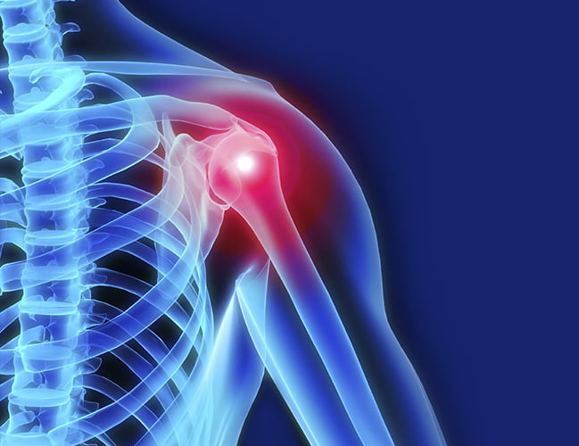Shoulder Bursitis