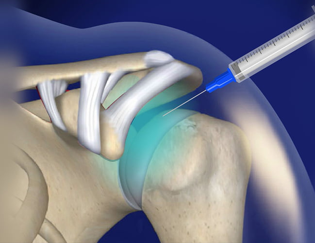 Shoulder Injuries