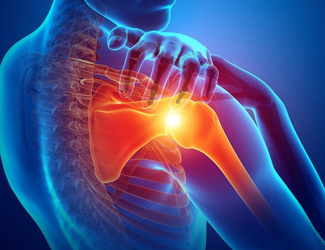 Shoulder Tendinitis