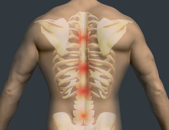 Lumbar Sprain/Lower Back Sprain NJ & NYC