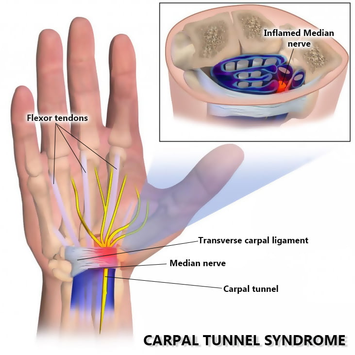 Median Nerve Injury - Symptoms, Causes, Treatment and Rehabilitation