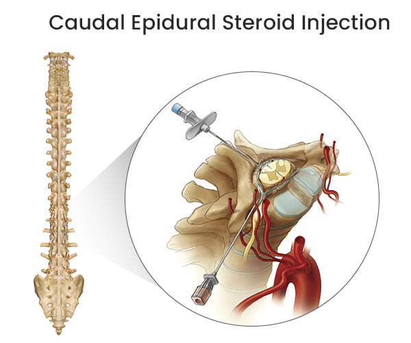 Caudal Epidural Steroid Injection