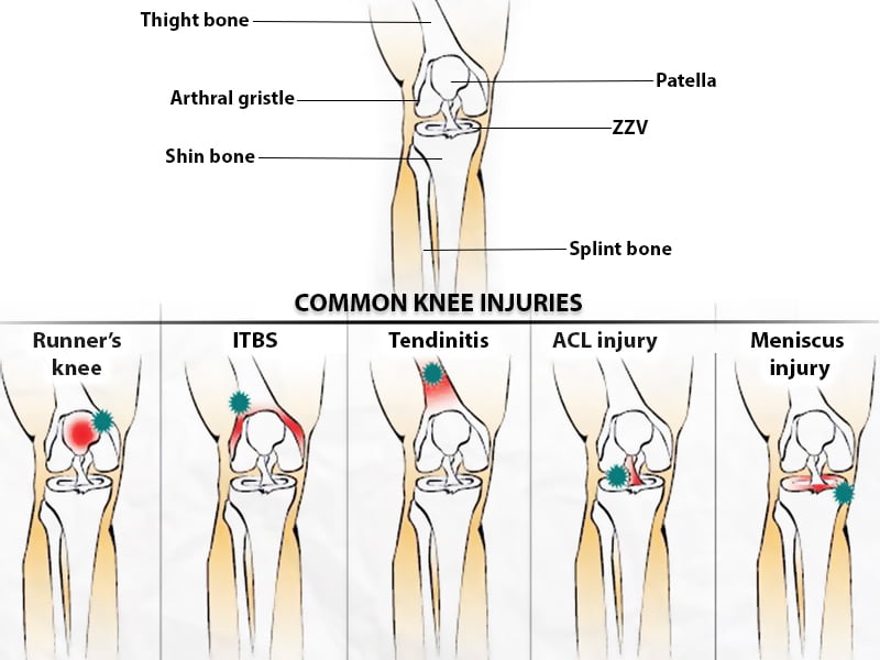 Is it a Sprain, Strain, or Tear? - New York Bone & Joint Specialists