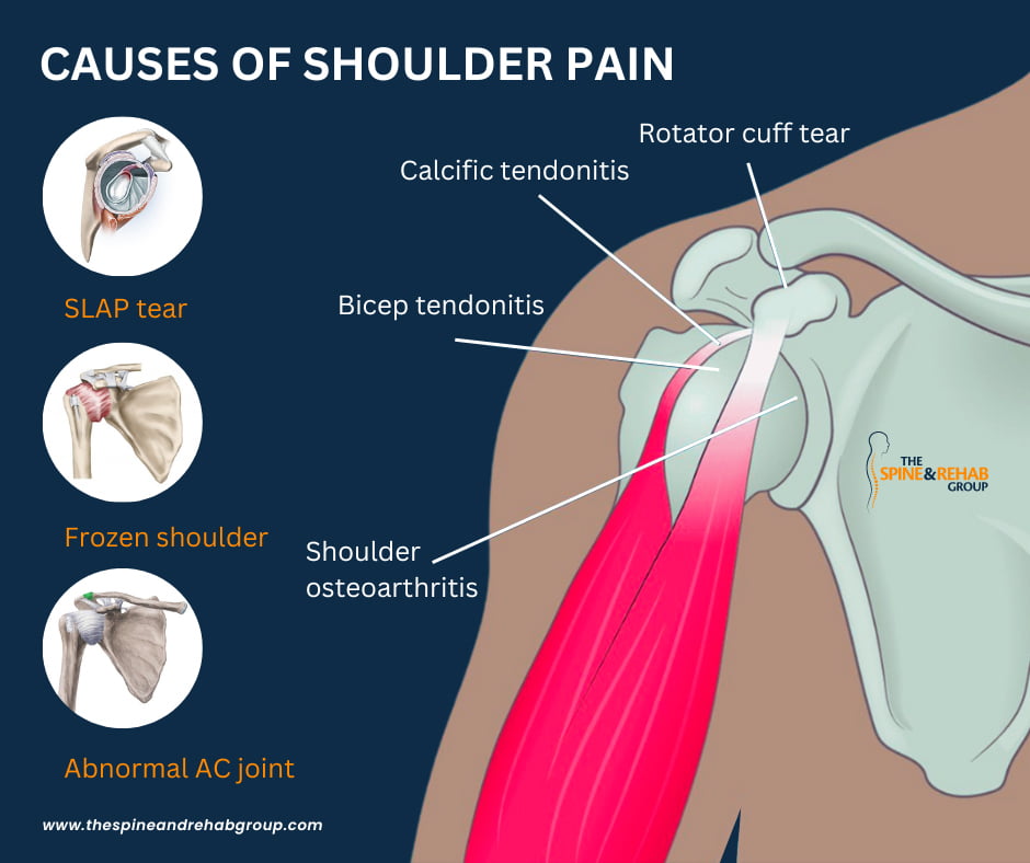 How To Resolve Right Neck And Shoulder Pain The Spine And Rehab Group