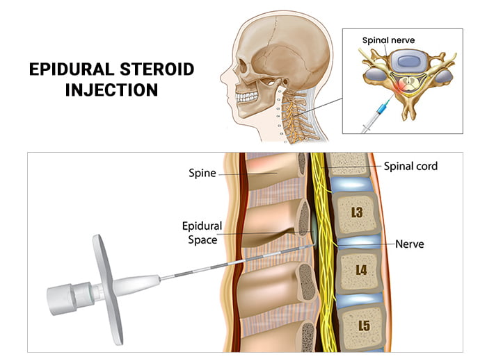 Lumbar Epidural Steroid Injections What It Is Benefits 51 OFF