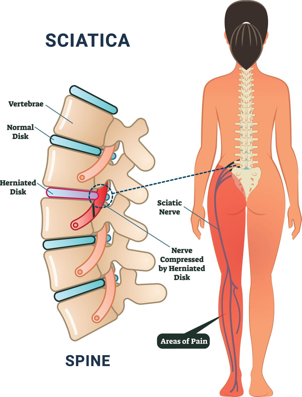 TENS Unit for Lower Back Pain: Placement and Instructions