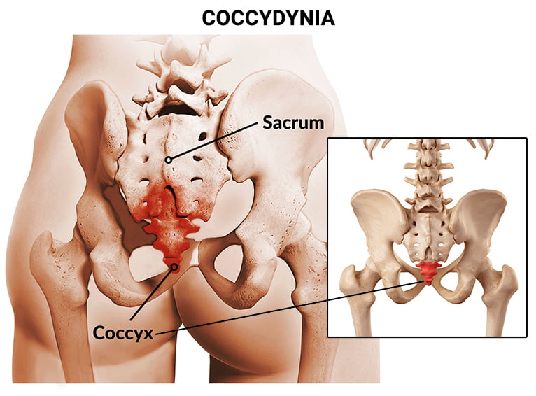 Coccydynia/Coccygeal Pain - The Orthopedic Pain Institute, Beverly Hills  Pain Management Specialist