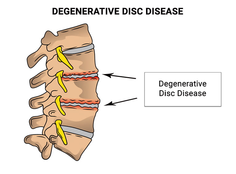 icd 10 code for degenerative disc disease of cervical spine