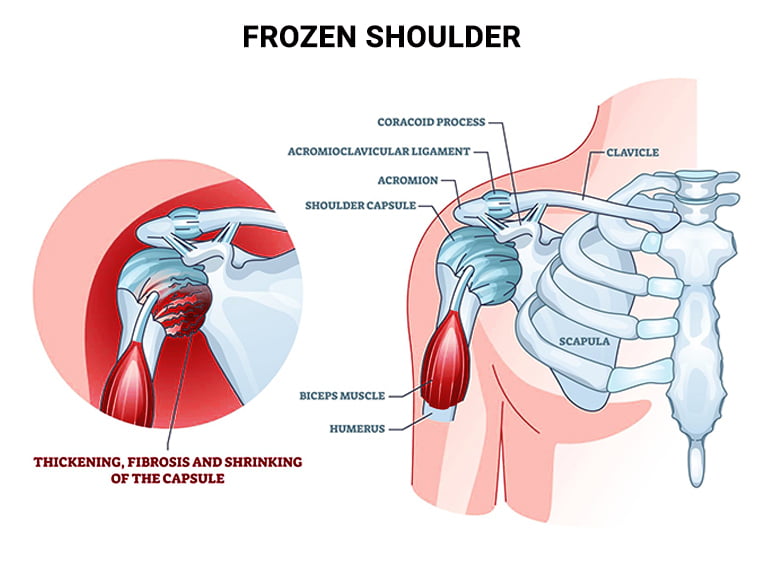 Treating Frozen Shoulder & Range-of-Motion Shoulder Injuries — RS Medical