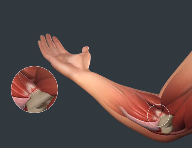 Golf Elbow