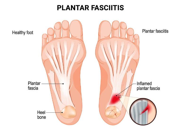 The Do's and Don'ts of Plantar Fasciitis | Lucky Feet Shoes