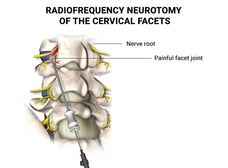 Radiofrequency Neurotomy of the Cervical Facets