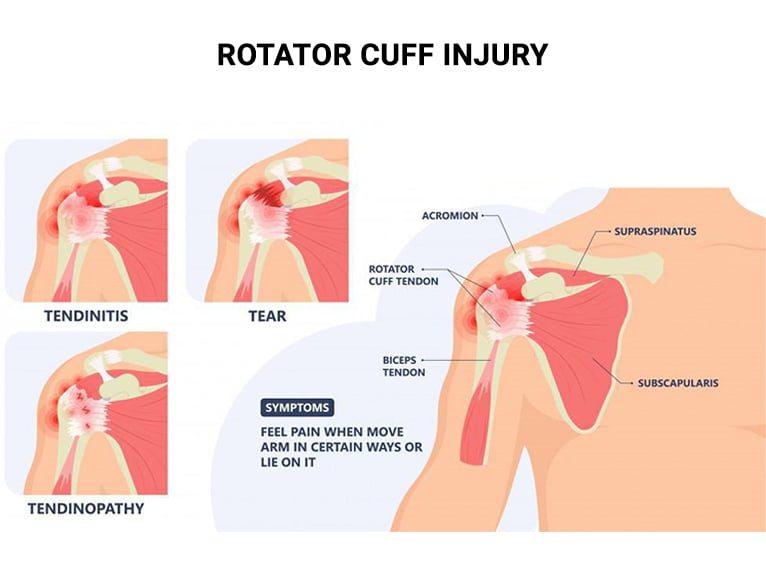 Rotator Cuff Injury Treatments in NJ & NYC