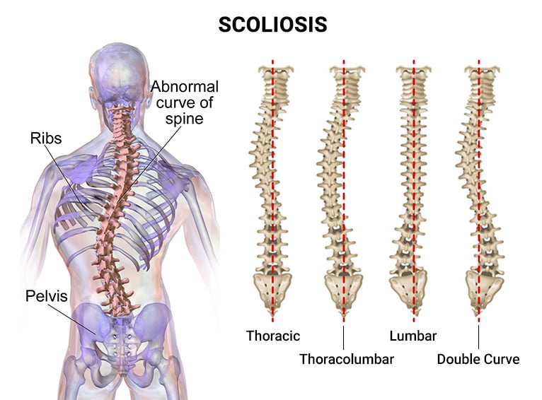 Scoliosis
