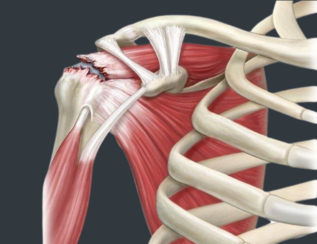 Shoulder Injuries