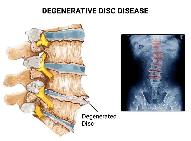 Degenerative Bandscheibenerkrankungen