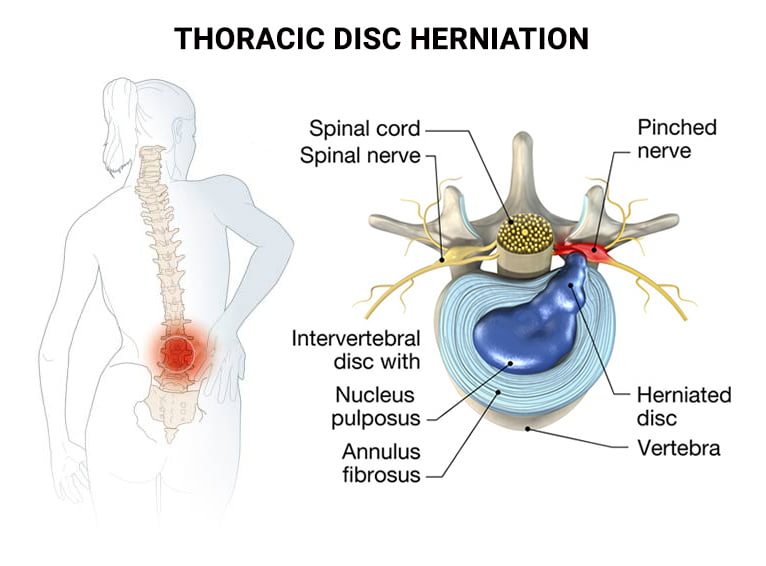 Thoracic Disc Herniation NJ & NYC