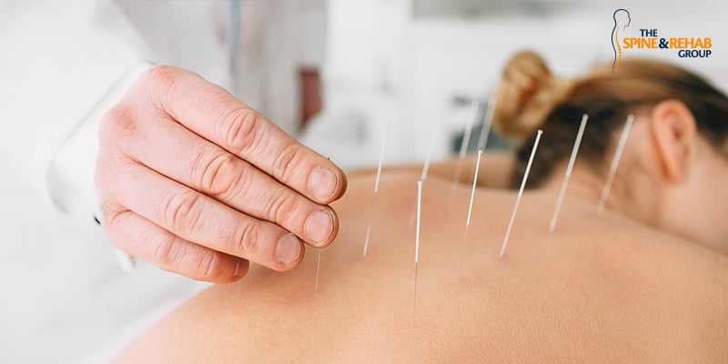 Can Acupuncture Relieve Sciatica Pain?