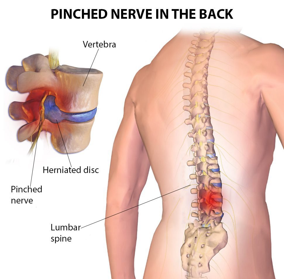 Pinched Nerve