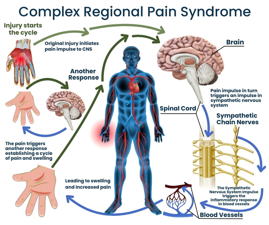 CRPS Specialist NJ | Complex Regional Pain Syndrome Doctor in New Jersey