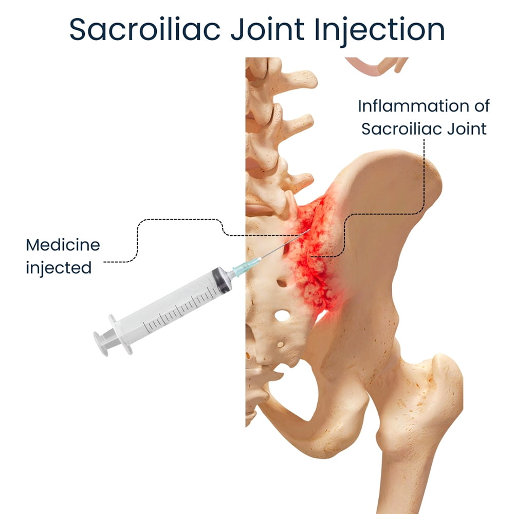 Sacroiliac Joint Injections